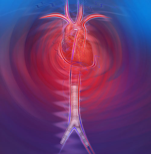 Endovascular stent graft treatment in the aorta