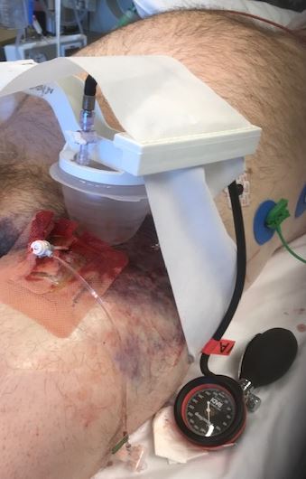 Compression device at a femoral access site in an archived JEVTM clinical case