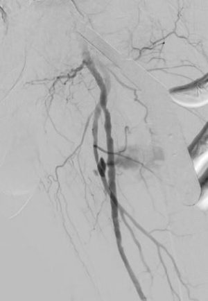 Angiographic image of the femoral artery from an archived JEVTM clinical case