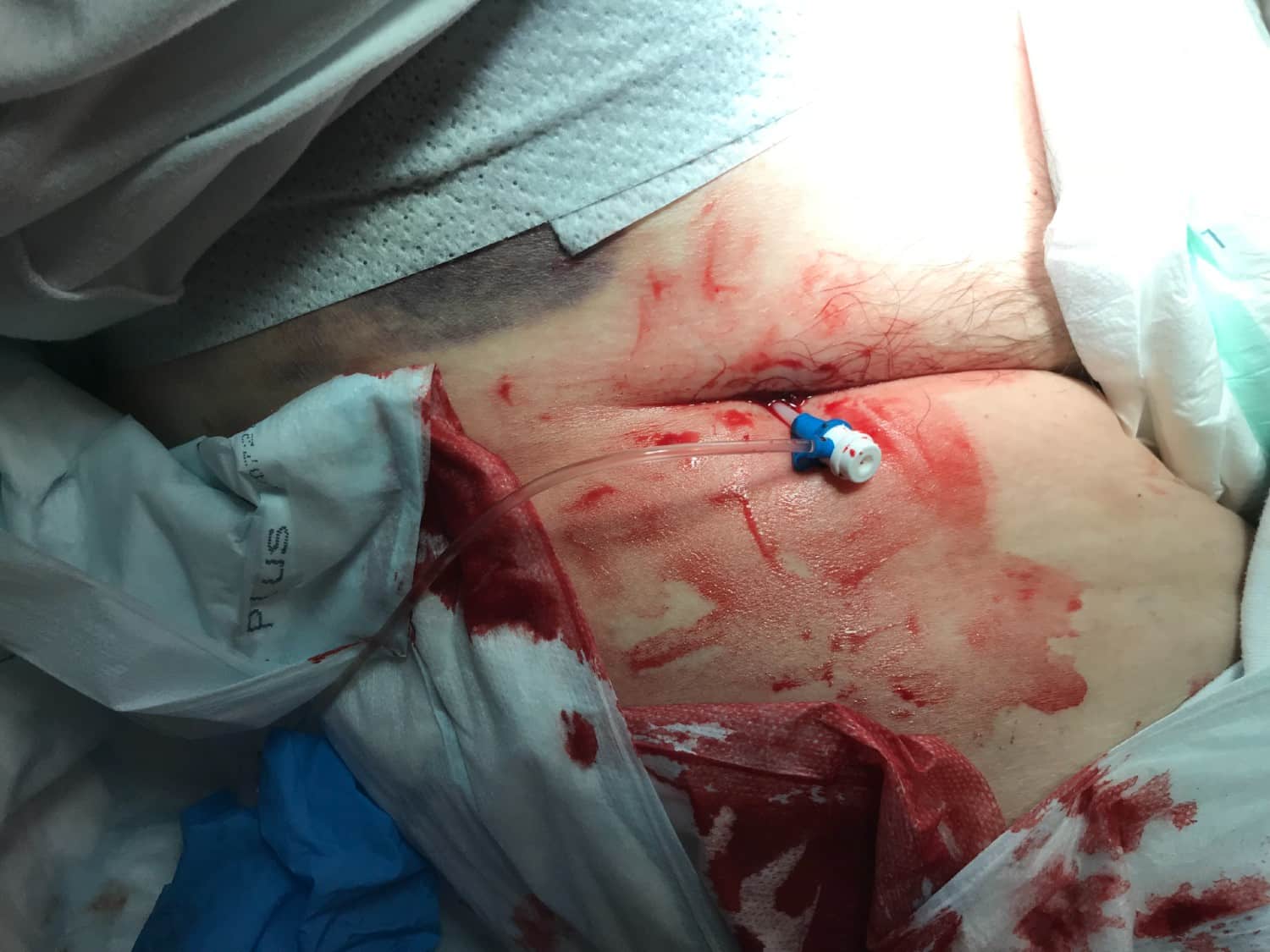 Femoral vascular sheath in place during emergency care
